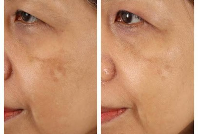 Scar Revision Treatments