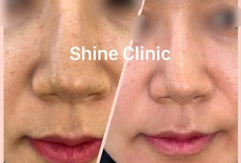 Stretch Mark Treatment