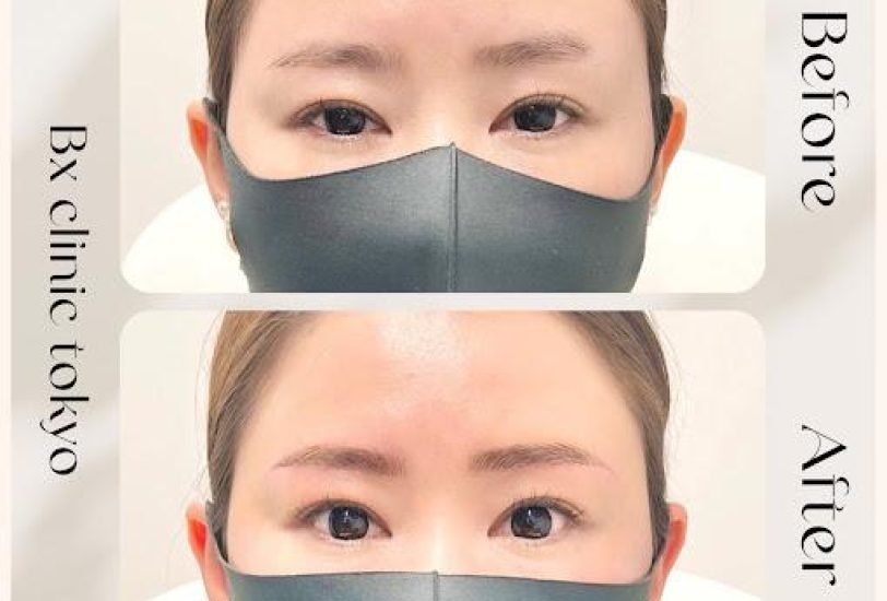 Eye Rejuvenation