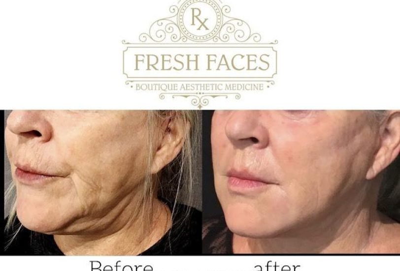 Skin Tightening