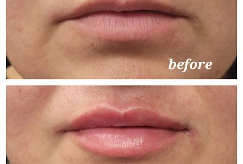 Lips Treatments