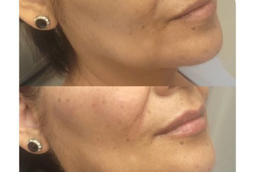 Injectable Treatments