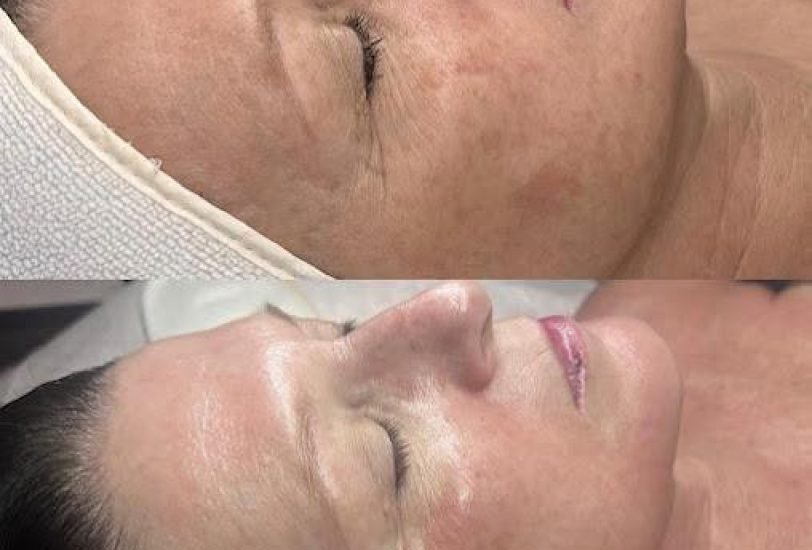 Double Chin & Jawline Contouring