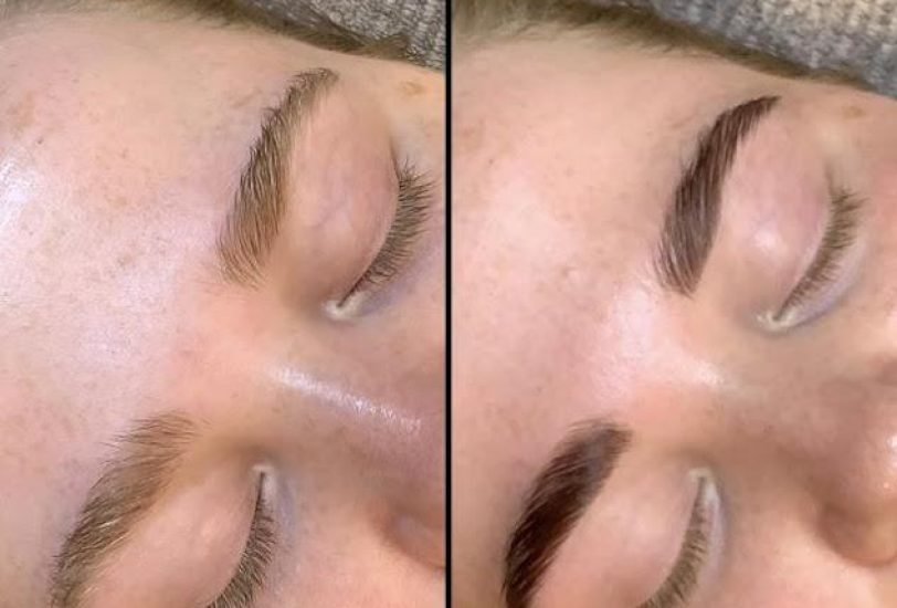 Eye Rejuvenation