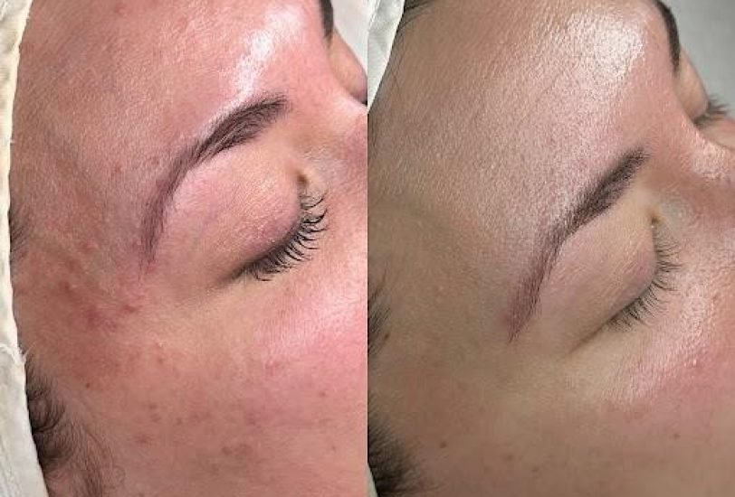 Skin Rejuvenation