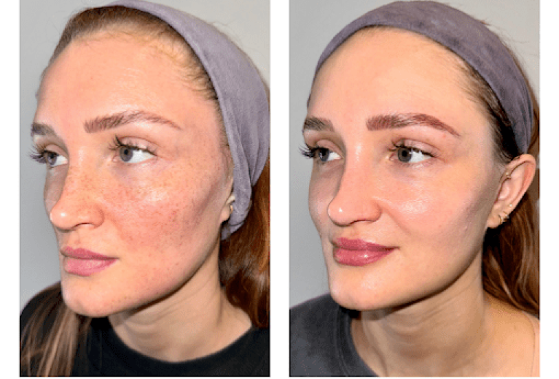 Laser & Light Therapies