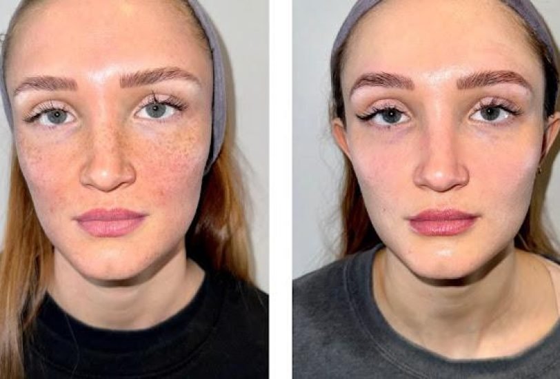 Injectable Treatments
