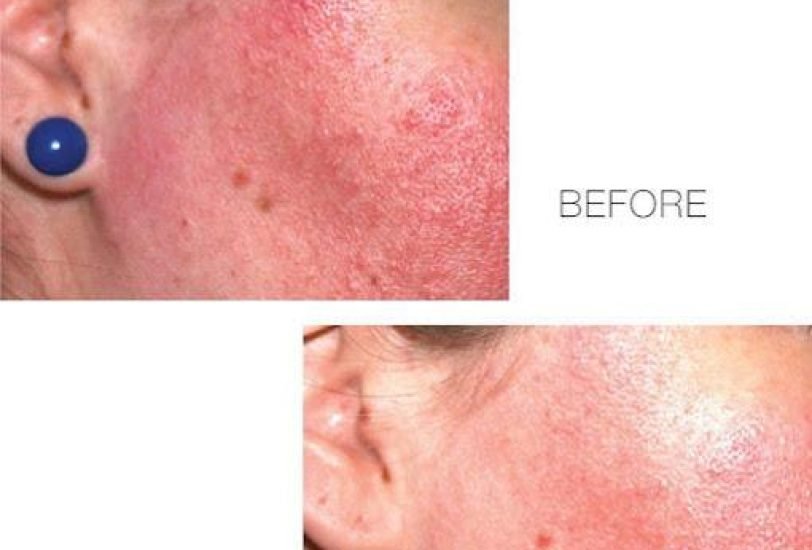 Skin Rejuvenation
