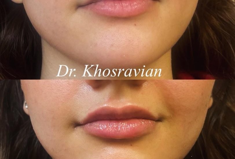 Lips Treatments
