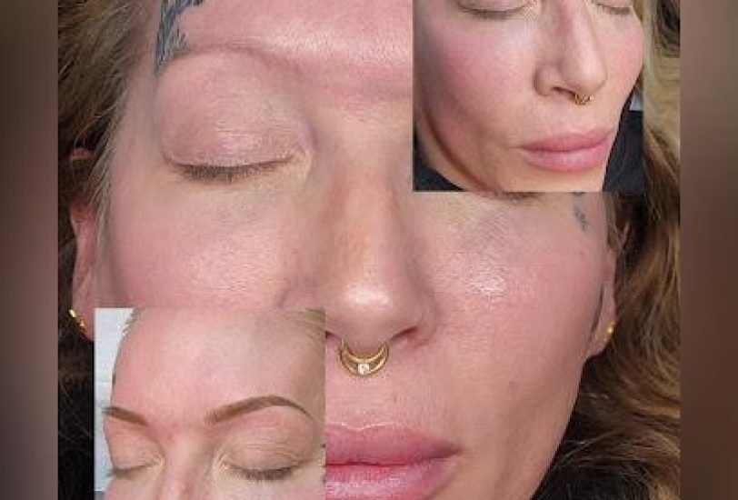 Acne & Scar Treatments