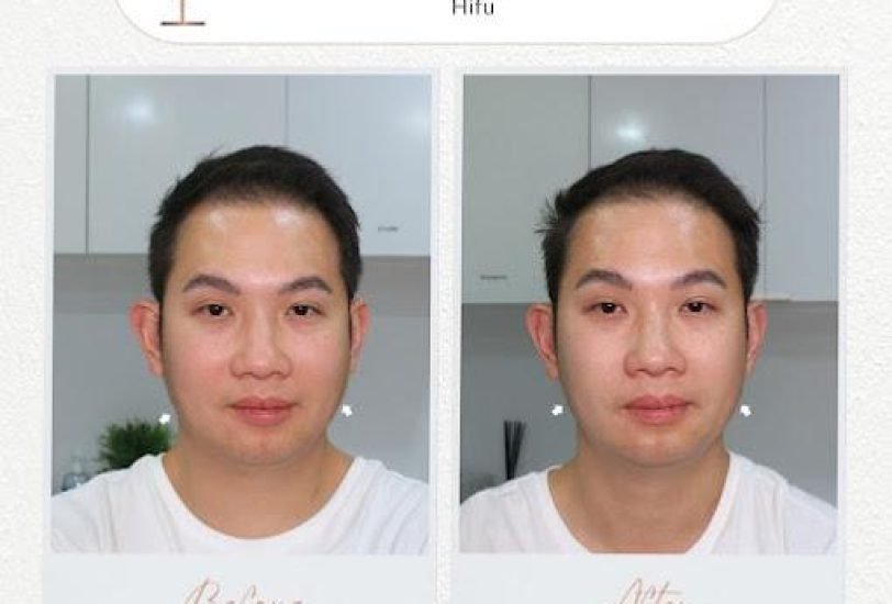 Double Chin & Jawline Contouring