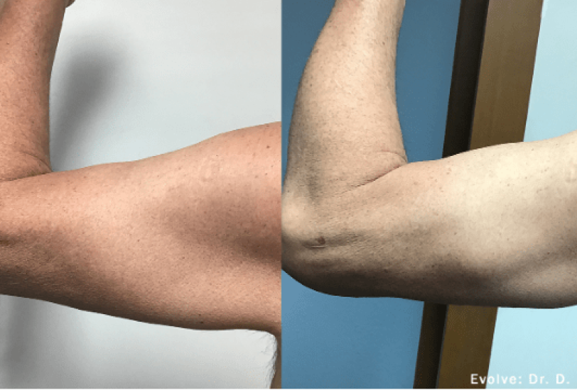 Body Contouring