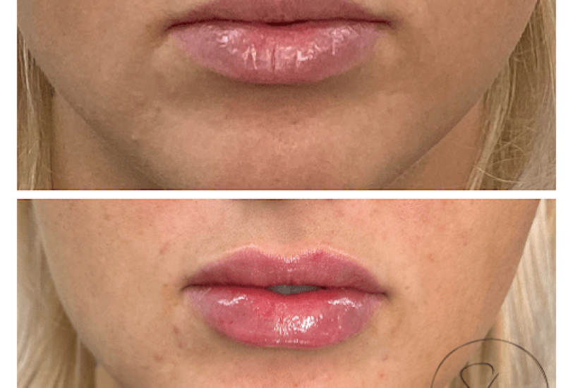Lips Treatments