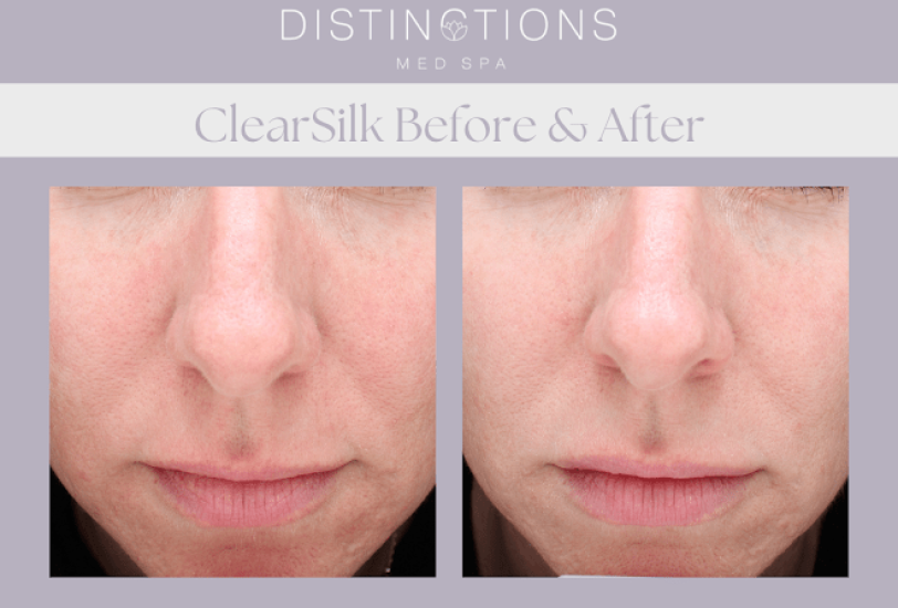 Skin Rejuvenation