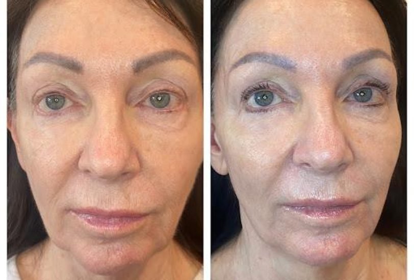 Double Chin & Jawline Contouring