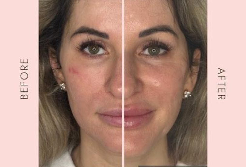 Injectable Treatments