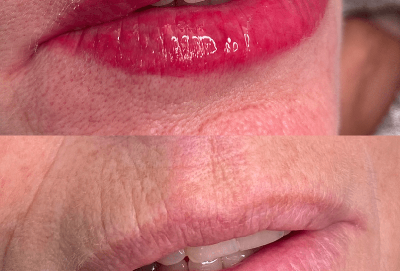 Lips Treatments