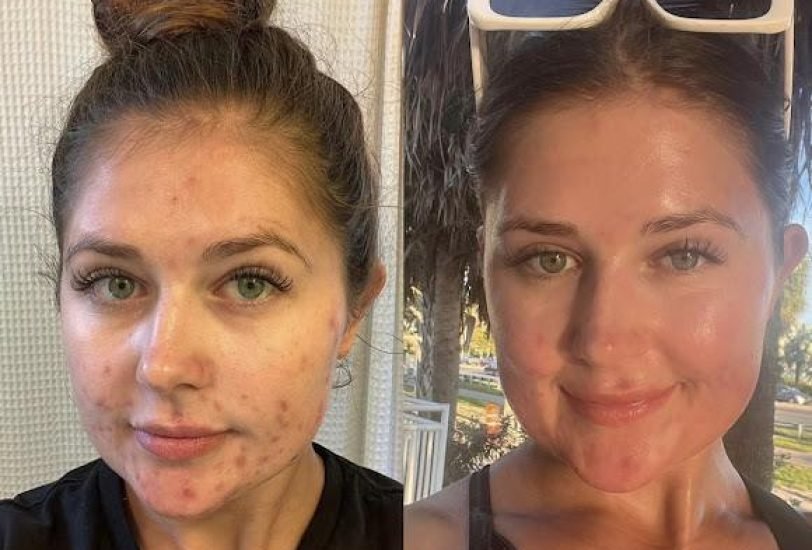 Double Chin & Jawline Contouring