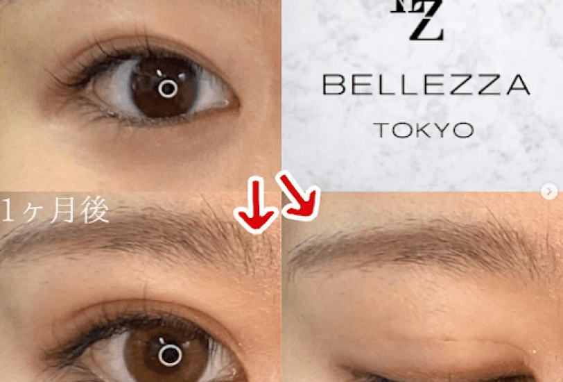 Eye Rejuvenation