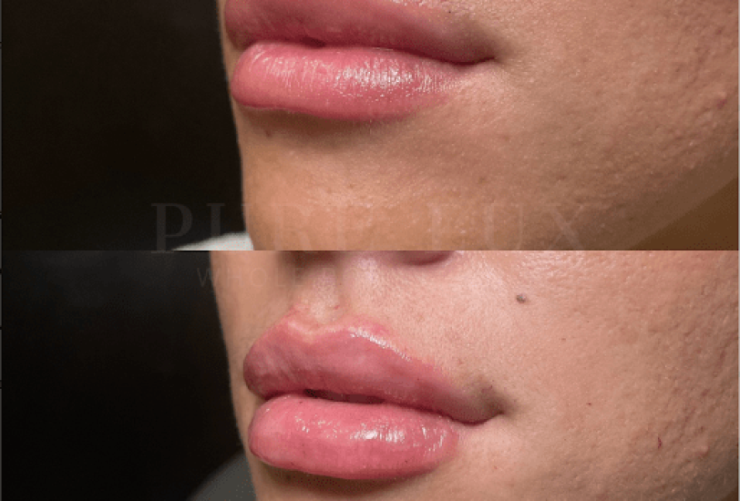 Acne & Scar Treatments