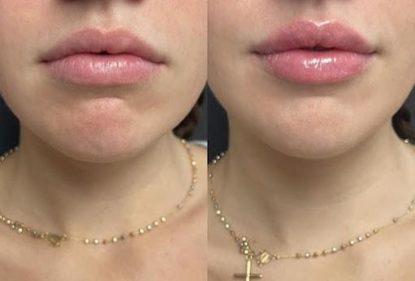 Injectable Treatments