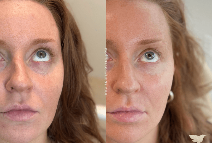 Skin Tightening