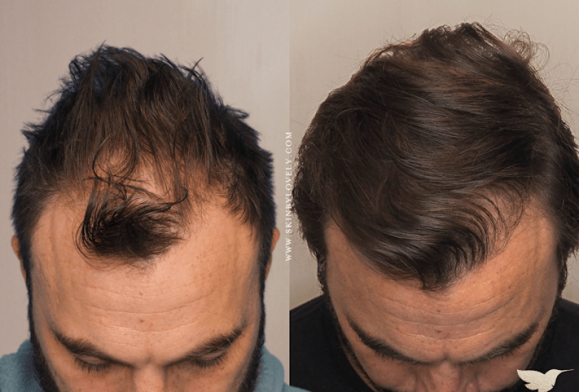 Injectable Treatments