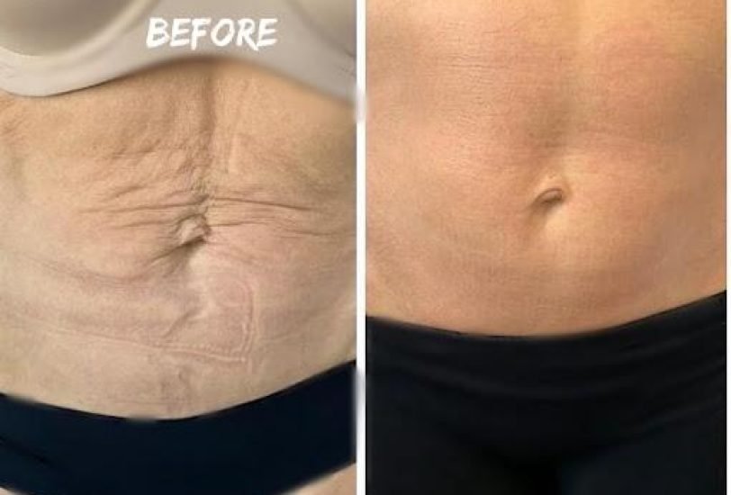 Cellulite Reduction