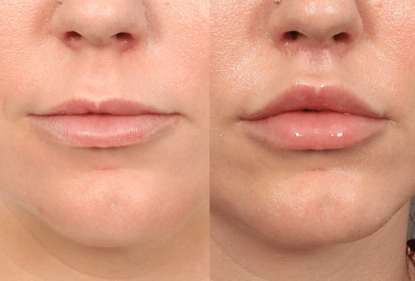 Lips Treatments