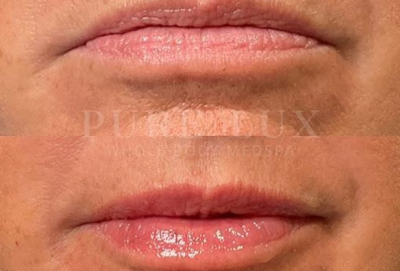 Lips Treatments