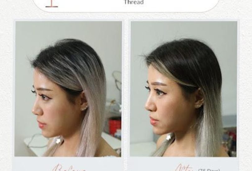 Facial Contouring & Lifting