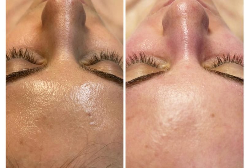 Acne & Scar Treatments