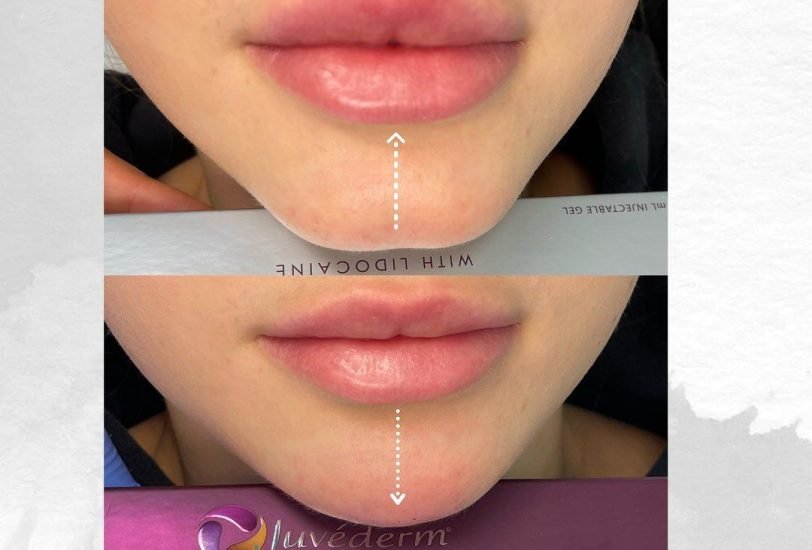Lips Treatments