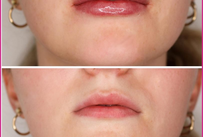 Lips Treatments
