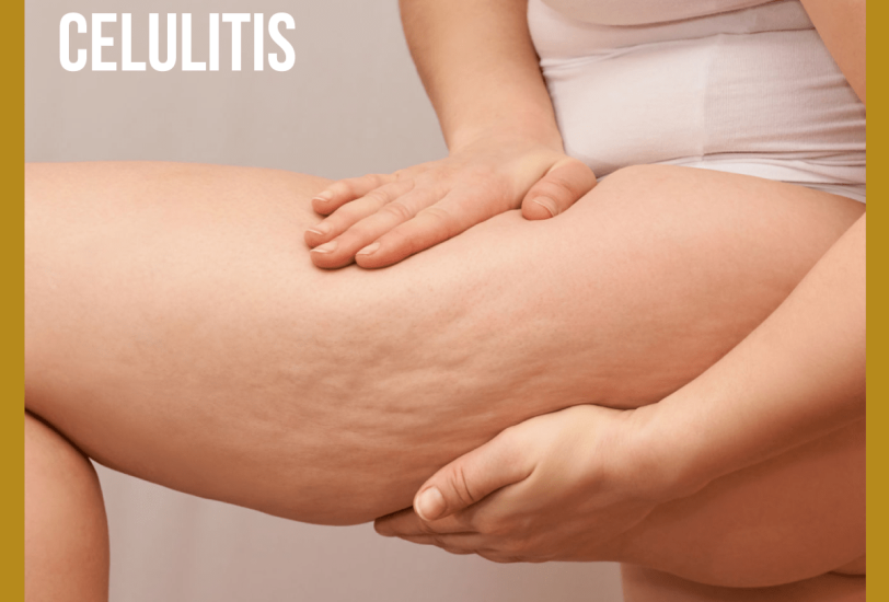 Cellulite Reduction