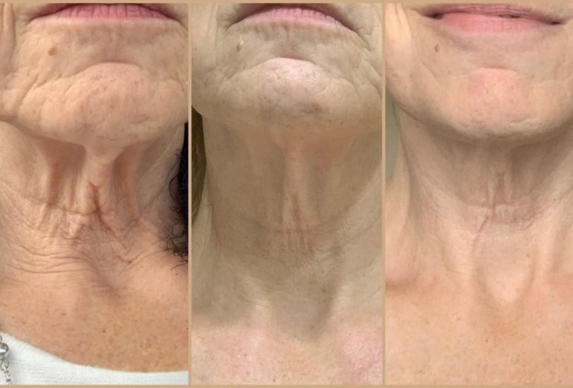Anti-Aging Treatments