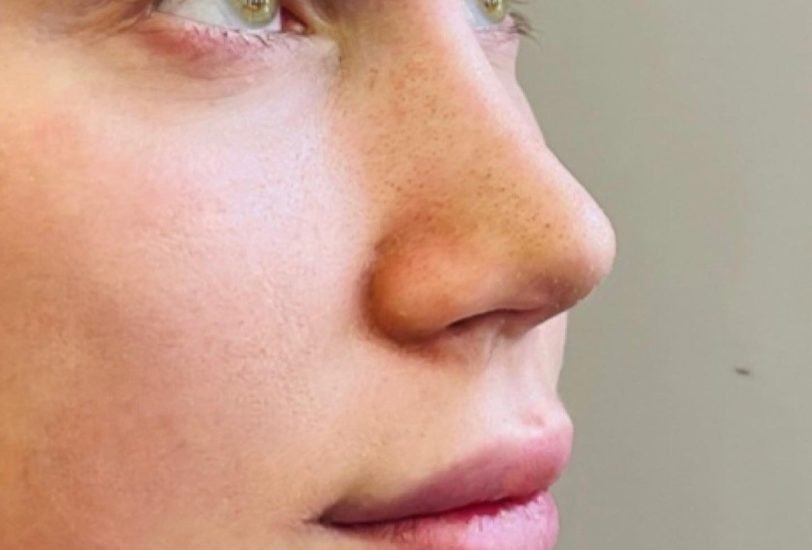 Scar Revision Treatments