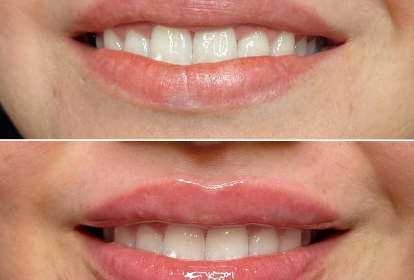 Lips Treatments