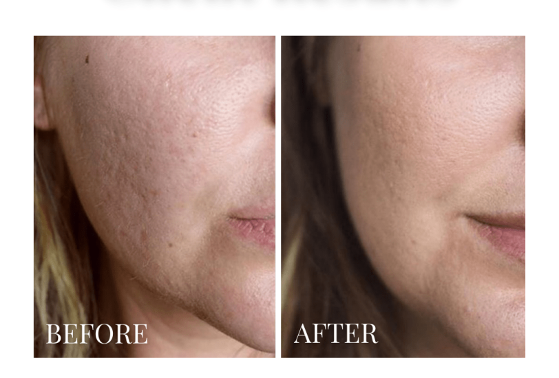 Acne & Scar Treatments