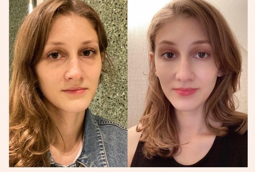 Facial Contouring & Lifting