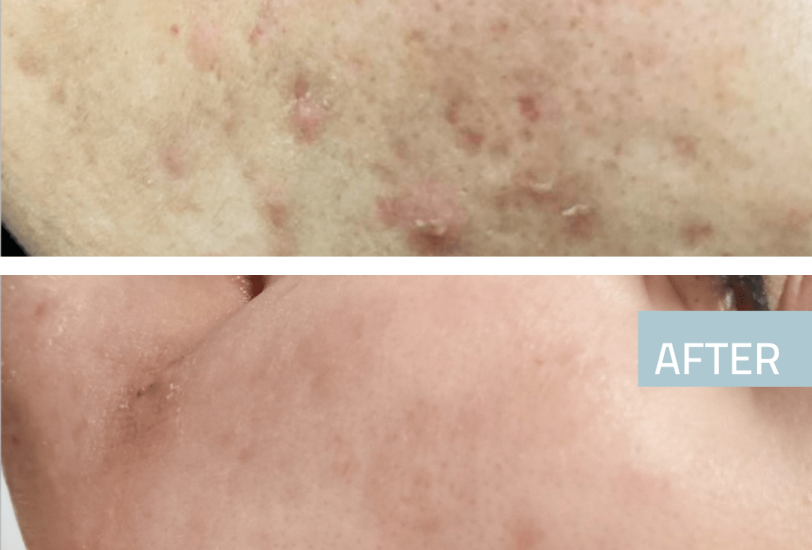 Acne & Scar Treatments
