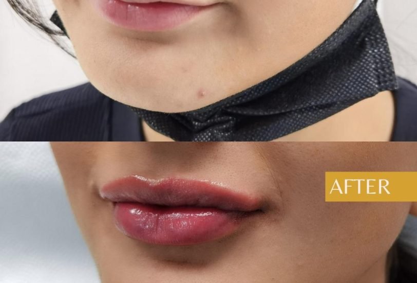 Lips Treatments