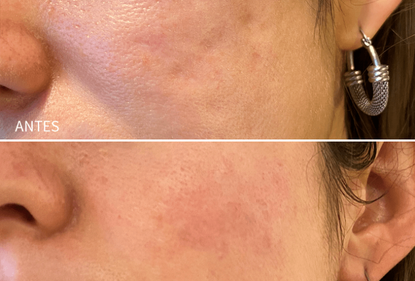Acne & Scar Treatments