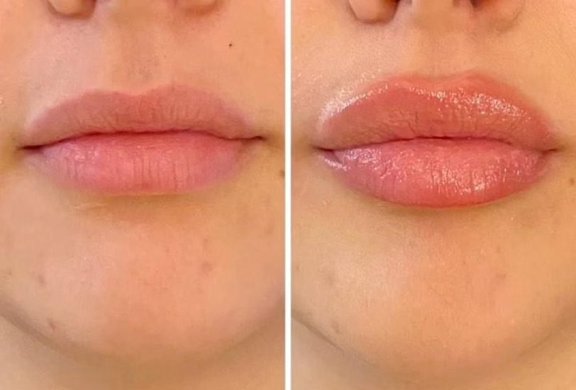 Injectable Treatments
