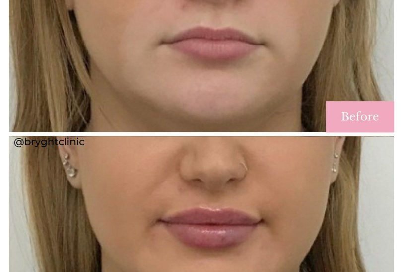 Lips Treatments