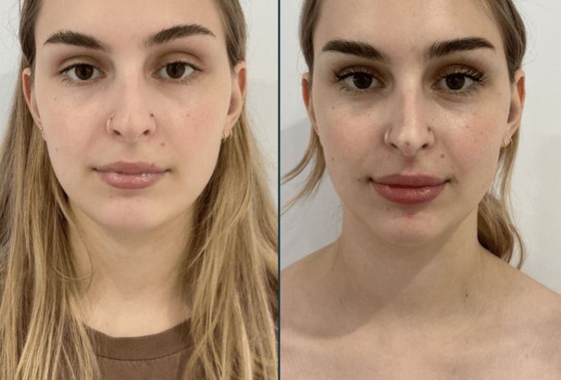 Injectable Treatments