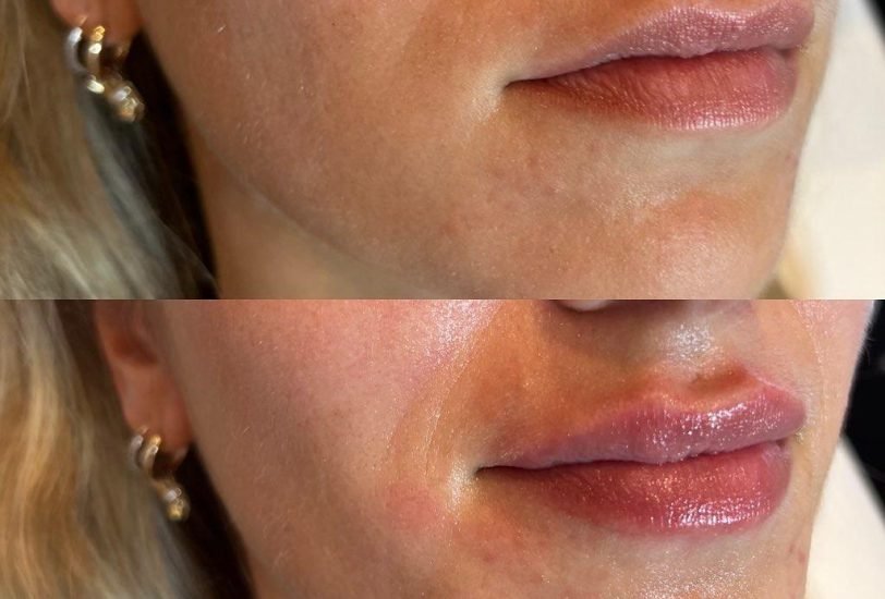Lips Treatments