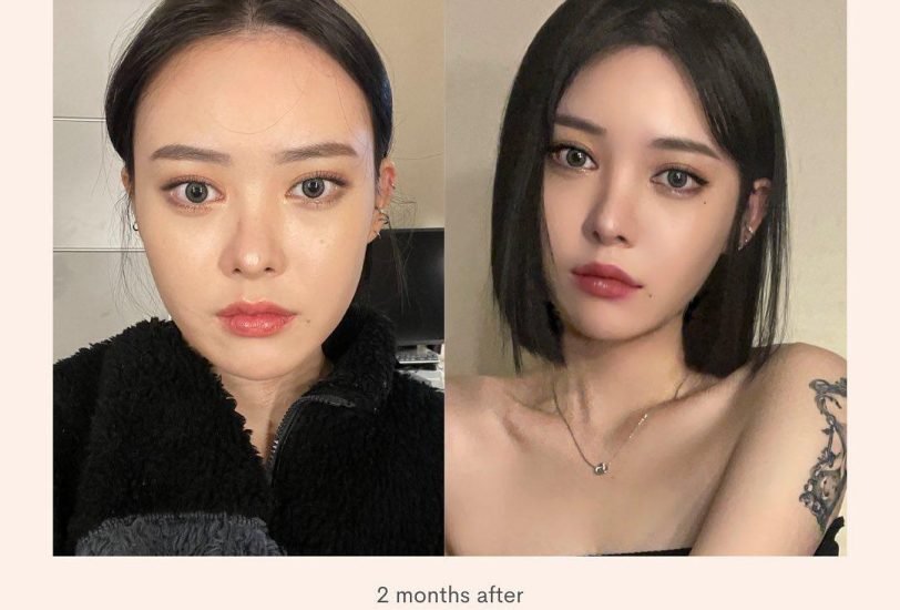 Double Chin & Jawline Contouring