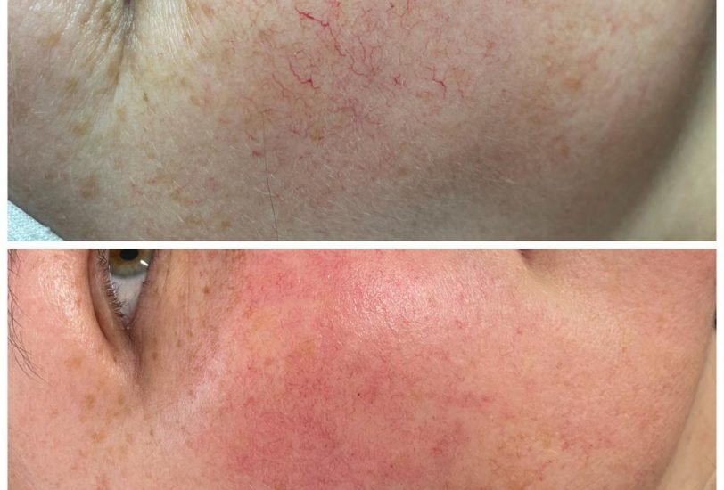 Skin Rejuvenation