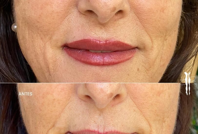 Lips Treatments